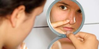 Hormonal imbalances can lead to acne in teens